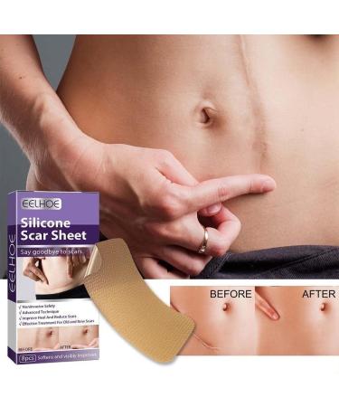 WAITLOVER Skin Color Reusable Silicone Scar Removal Patch - Surgical Self-Adhesive Soft Gel Strip for Burn Repair - Buy Online on GoSupps.com