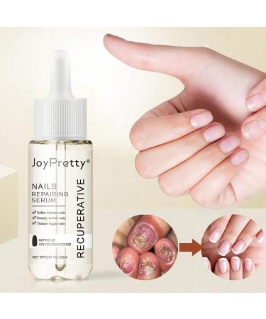 ILOVMUP Nail Cuticle Oil Nail Treatment for Dry & Damaged Nails Cuticle Care Oil for Fungal Nail & Toenails Strength Nail Oil for Moisturizing and Repairing Cracked Nail - 20ml - Buy Online on GoSupps.com