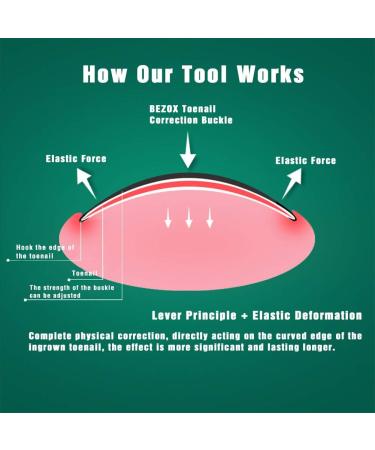 Bezox 2PC Ingrown Toenail Tools - Nail Correction Buckle & Lifter Surgical Stainless Steel for Paronychia Treatment (Size 37-40) | International Shipping Available - Buy Online on GoSupps.com