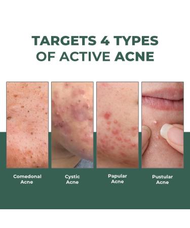 C.o.n.s.c.i.o.u.s C.h.e.m.i.s.t Rapid Relief Acne Spot Corrector Gel Salicylic Acid Azelaic Acid Sulfur 6 Hours 15ml - Buy Online on GoSupps.com