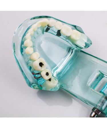Buy Lmeil Transparent Dental Teeth Model - Ideal for Implantation & Dentist Research | Pathological Dental Model - Buy Online on GoSupps.com