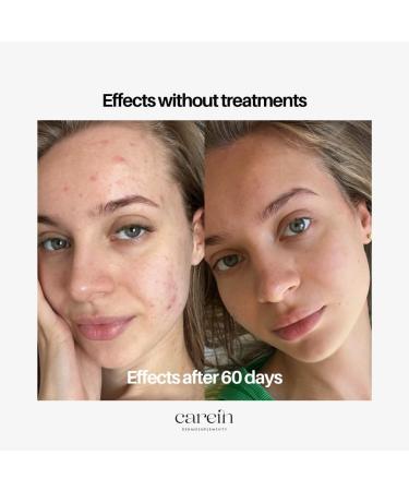  Carein Dermosupplement Acne Skin - 120 Capsules for Clear and Healthy Skin Without Acne Gluten Free and Sugar Free - Buy Online on GoSupps.com