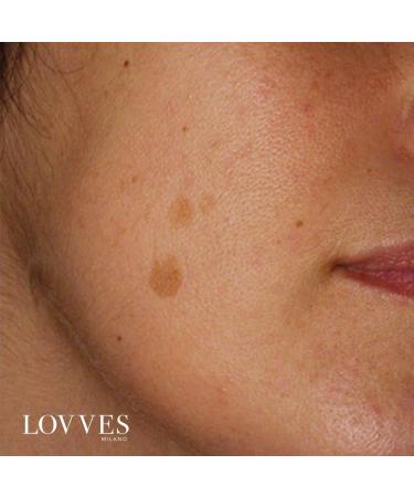 LOVVES Antiblemish facial serum Brightening High Natural Cosmetics Depigmenting Reduces Hyperchromia of the Skin Prevents the Formation of New Pimples Smoother Skin 30 ml - Buy Online on GoSupps.com