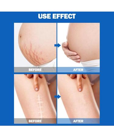 Essential Stretching Strip Oil | Moisturizing Skin Repair for Belly Breasts Buttocks & Thighs | Ideal for Mothers & Women - Buy Online on GoSupps.com