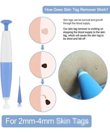 Skin Cleaing Tool Kit for Men and Women Skin Cleaning Kit for Small (2mm) to Medium (4mm) Skin Tags Safe for Most Parts(Blue) - Buy Online on GoSupps.com