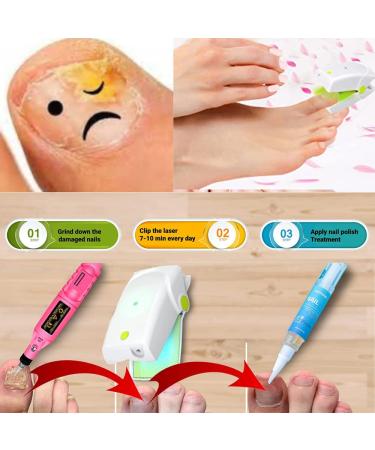 Laser Toe Nail Fungus Treatment Kit with Extra Strength Laser, Nail Drill, and Treatment Pen 2023 - Buy Online on GoSupps.com