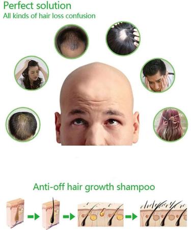 Lucoss Anti-Hair Loss Shampoo Improve Hair Quality Natural Herbal Extract Shampoo Best Hair Growth Shampoo Stimulates Hair Growth Helps Stop Hair Loss Grow Hair Fast Hair Loss Treatment. - Buy Online on GoSupps.com
