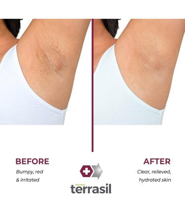 Terrasil Folliculitis Soap - Calendula-Infused Natural Bar for Folliculitis Relief - Anti-Itch Treatment - 3 Pack, 75gm Bars - Buy Online on GoSupps.com