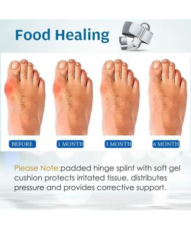Gray Bunion Corrector Splint - Non-Surgical Hallux Valgus Correction & Pain Relief - Buy Online on GoSupps.com