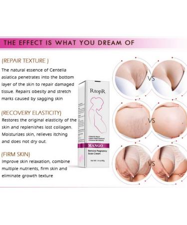 Mango Stretch Marks & Scar Cream (40g) | Pregnancy & Obesity Scar Removal - Wrinkle Reduction & Moisturizing - Buy Online on GoSupps.com