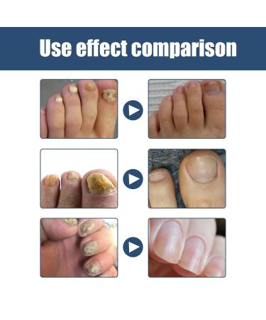 3 Pcs Furzero Athletes Foot & Nail Treatment Spray - Medical Grade Anti-Fungal Formula for Foot & Nail Fungus - Nail Repair Spray - Buy Online on GoSupps.com