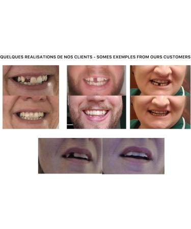 CREADENT Temporary Cosmetic Tooth Replacement Kit - Easy DIY Solution - Buy Online on GoSupps.com