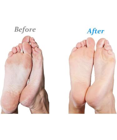 Emjoi Micro-Pedi Extra Coarse Refill Rollers for Tough Calluses - Genuine Quality - Buy Online on GoSupps.com