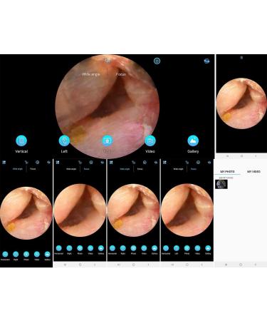 Buy Newgen Medicals E Ear Cleaner | WLAN Ear Cleaner with Full HD Camera & App Live View - 8 Accessories Included - Buy Online on GoSupps.com