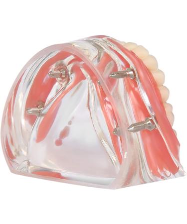 Samnuerly Dental Model with Down-Implant Deck - 4-Nail Teeth Demo for Teaching and Patient Communication | Transparent Educational Tool - Buy Online on GoSupps.com