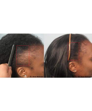 Black Seed Oil for powerful Hair growth - Thick and Full - Buy Online on GoSupps.com