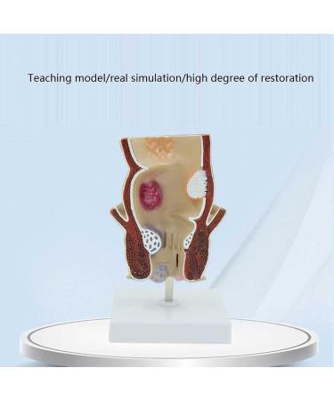 Human Rectal Hemorrhoid Lesions ical Model Colon Anal Sphincter Anorectal Teaching Specimen - Buy Online on GoSupps.com