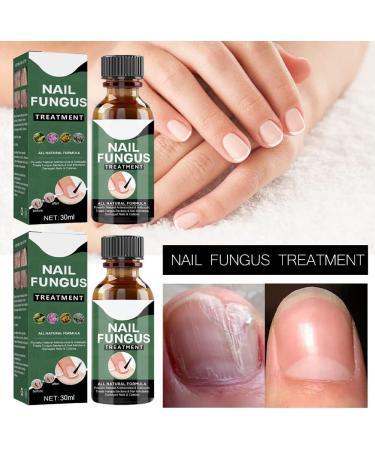 Antifungal Nail Treatment for Damaged Nails - Toe Care Solution for Renewing Discolored Feet - Buy Online on GoSupps.com