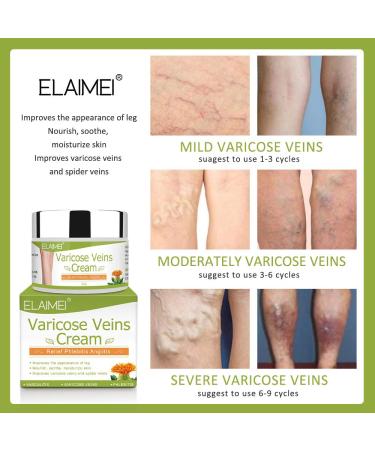 Varicose Veins Cream - Treatment for Phlebitis, Angiitis, Vasculitis, Spider Veins - Improve Blood Circulation for Tired, Heavy Legs - Fast Relief - Buy Online on GoSupps.com