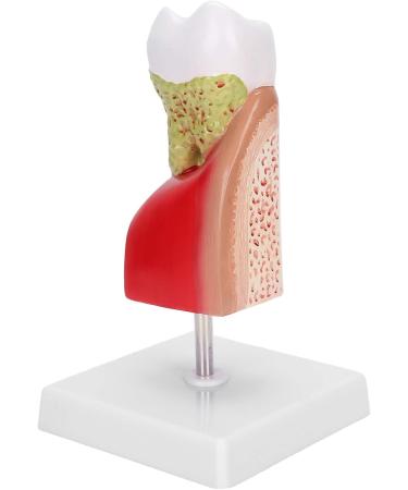 Verdant Touch Tooth Model - Dental Caries Teaching & Training Aid for Patient Education - International Shipping - Buy Online on GoSupps.com