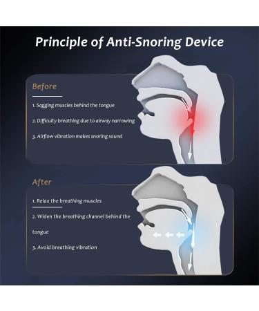 Smart Electric Anti Snoring Stopper | USB Rechargeable Snoring Device for Better Nose Breathing and Improved Sleep - Buy Online on GoSupps.com