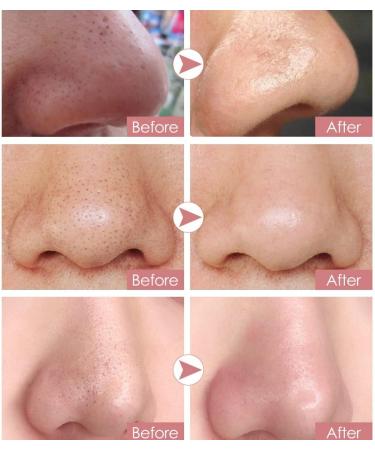 Blackhead Remover Clear-Up Strips - Deep Cleansing Nose Pore Strips (10 PCS) - Buy Online on GoSupps.com