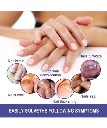 ZERZK 10ml Repair Nail Fungus Treatments Essence Foot Care Nails AntiInfection Toe Fungus Serum Onychomycosis Removal Gel - Buy Online on GoSupps.com