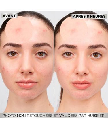 GARNIER Pure Active - XXL Pimple Patch Pack - Reduces the Appearance of Pimples in 8H* - Clinically Proven - Invisible & Ultra-Thin - Hydrocolloid Technology - Vegan & Cruelty-Free - Men & Women - Buy Online on GoSupps.com