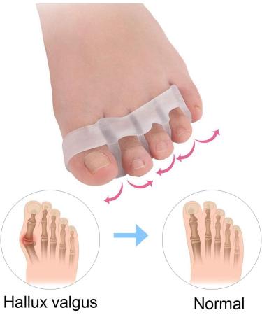 Bunion Corrector Toe Separators - 2 Pairs Silicone Gel Toe Straighteners for Overlapping Toes, Hallux Valgus, and Foot Pain Relief - Men and Women - Buy Online on GoSupps.com