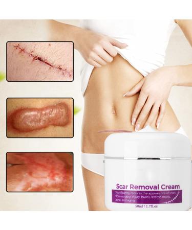 Scar Removal Cream with Plant Extracts - Fades Scars, Stretch Marks & Skin Damage - Buy Online on GoSupps.com