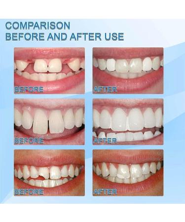 TAIHE Tooth repair kit DIY tooth replacement temporary tooth repair kit temporary tooth repair kit temporary teeth tooth filling material thermal adhesive beads for missing and broken teeth - Buy Online on GoSupps.com