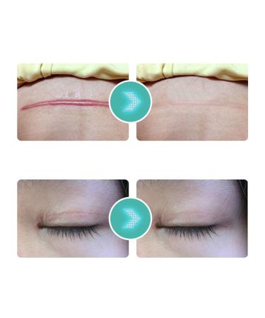 Hypoallergenic Silicone Scar Strips for Hyperplastic Scars - Waterproof & Breathable - Ideal for Women - Home & Travel Use - Buy Online on GoSupps.com