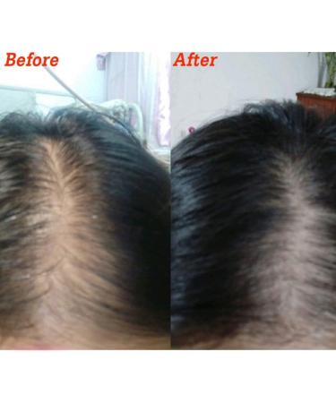 Symeas Hair Regrowth Serum Derma Scalp Intensive Ampoule Triple Roll Massager Scalp Revitalizer Anti Hair Loss Thinning Balding Hair Treatment Essential Oil - Buy Online on GoSupps.com