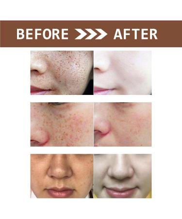 Glutathione Face Cream Freckle Remover Cream Dark Spot Correcting Glow Serum Dark Spot Corrector Correct Black Spots and Brighten the Skin Facial Dark Spots Remover - Buy Online on GoSupps.com