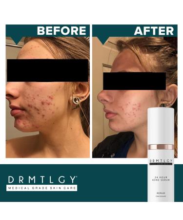 DRMTLGY Acne Spot & Cystic Treatment Serum - 5% Benzoyl Peroxide & Glycolic Acid - Buy Online on GoSupps.com