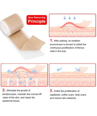 IGOOLEE Silicone Scar Sheets Strips Tape - 3 Reusable Rolls for Surgical Scar Removal - 1.57 x 120 Size - Ideal for Keloid & C-Section Scars - Buy Online on GoSupps.com