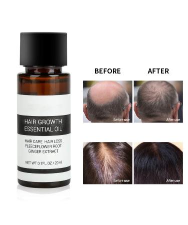 Hair Growth Essence Oil for Men & Women - 20ml Thickening Tonic | Anti Hair Loss & Growth Accelerator - Buy Online on GoSupps.com