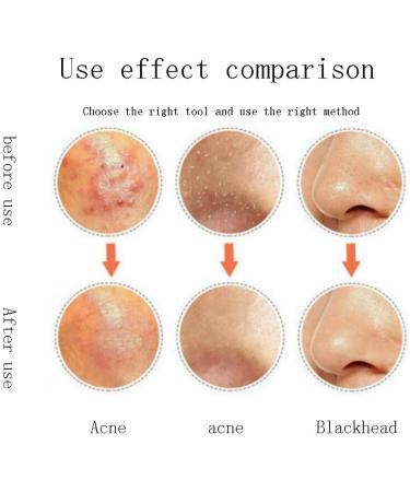 5 Pieces of Stainless Steel Blackhead Wrinkle Removal Clip Blackhead Acne Extractor Stainless Steel Beauty Tool for Female Girls B - Buy Online on GoSupps.com