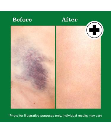 Miracle Plus Natural Arnica Bruise Body Gel - Extra Strength Vitamin K Cream for Bruising Swelling & Thin Skin - 4 Oz Arnica Ointment for Post-Surgery Skin Care - Buy Online on GoSupps.com