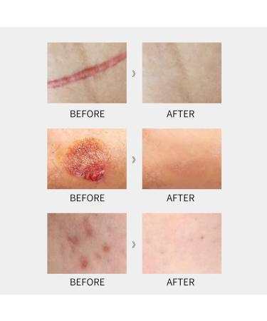 Scar Gel for Face Advanced Scar Remover Anti Scar Cream for Face Silicone Scar Gel Scar Cream Scar Removal Cream for Cesarean Burns and - Buy Online on GoSupps.com
