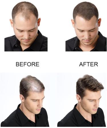 DUBUSH Purc Natural Hair Growth Serum & Hair Growth Oil Set Purc Natural Ginger Hair Growth Oil Prevent Hair Loss Scalp Care Fast Hair Growth Products - Buy Online on GoSupps.com