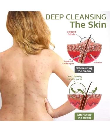 DUBUSH Keratosis Hair Cream Hair Follicle Repair Cream Chicken Skin Smoothing Cream Keratosis Hair Treatment Cream for Rough and Dented Skin - Buy Online on GoSupps.com