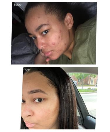 Dark Spot Corrector & Brightening Serum with Kojic Acid, Vitamin C, Salicylic Acid & More | Melasma Treatment Cream by Admire My Skin - Buy Online on GoSupps.com