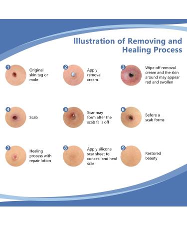 Skin Tag & Mole Remover Kit - Remove Without Scars | Skin Tag Removal Lotion & Silicone Scar Sheet - Buy Online on GoSupps.com