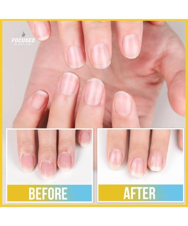 Teenitor Cuticle Remover Kit - Complete Nail Care Set with Cuticle Oil File Buffer & Pusher | Milk & Honey | International Shipping - Buy Online on GoSupps.com