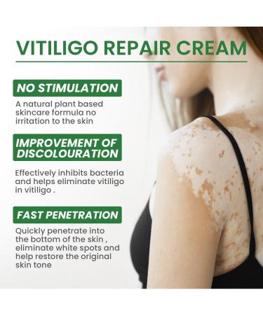 Revitalize Eelixirs Vitiligo Cream Treatment Ointment | Repigmentation & Soothing Moisturizer for Skin | Vitiligo Fix - 1pcs - Buy Online on GoSupps.com