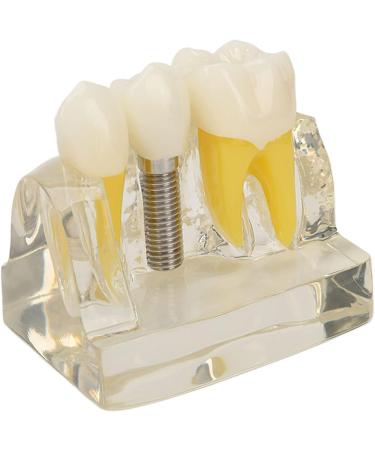Verdant Touch Dental Implant Model | Transparent Dental Implant for Teaching & Research | International Shipping - Buy Online on GoSupps.com