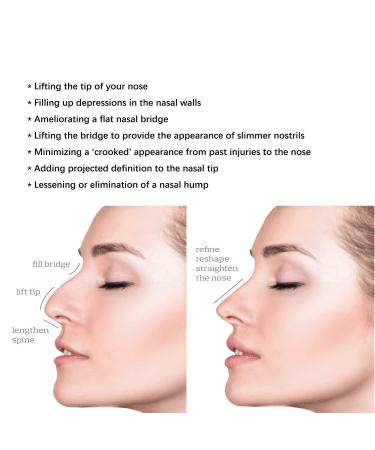 Elves PDO Nose Thread Lift/Nasal 4d COG Pdo Threads for Nose - 19G60mm - Buy Online on GoSupps.com
