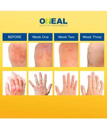 Manuka Honey Eczema Cream - Tinea Treatment for Athletes Foot Ringworm & Psoriasis - 3.4 oz Relief for Dry Skin & Dermatitis - Buy Online on GoSupps.com