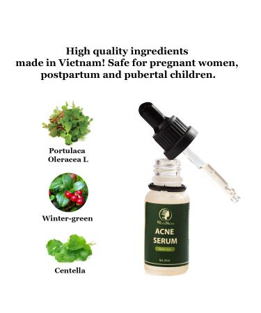 Buy Acne Serum (0.7 fl oz) | Fast International Shipping & Clear Skin Solution - Buy Online on GoSupps.com